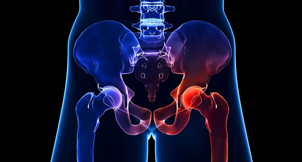 Hip Calcification